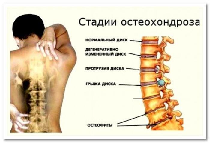 Схема медикаментозного лечения остеохондроза поясничного отдела позвоночника