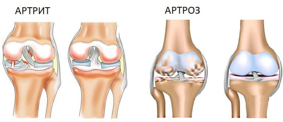 Лекарства при артрите коленного сустава