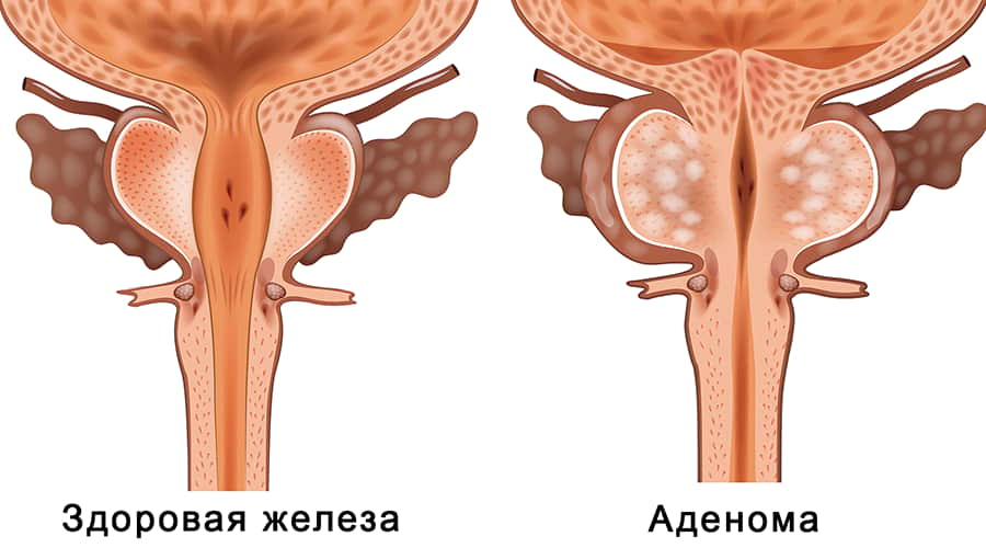 simptomi adenomi prostaty